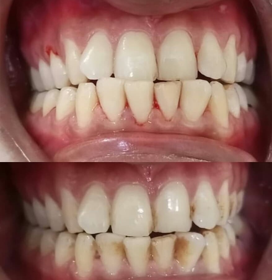 Emax Veneers Treatment